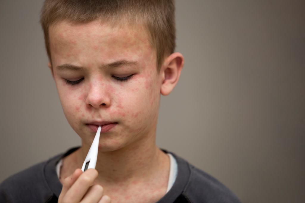 boy with measle bumps on face